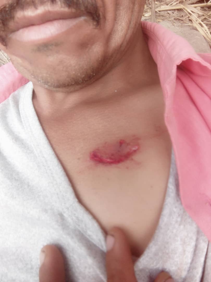 كلاب مسعورة تهاجم مواطنين في تورصة بالضالع وتصيب أثنين بجروح خطيرة