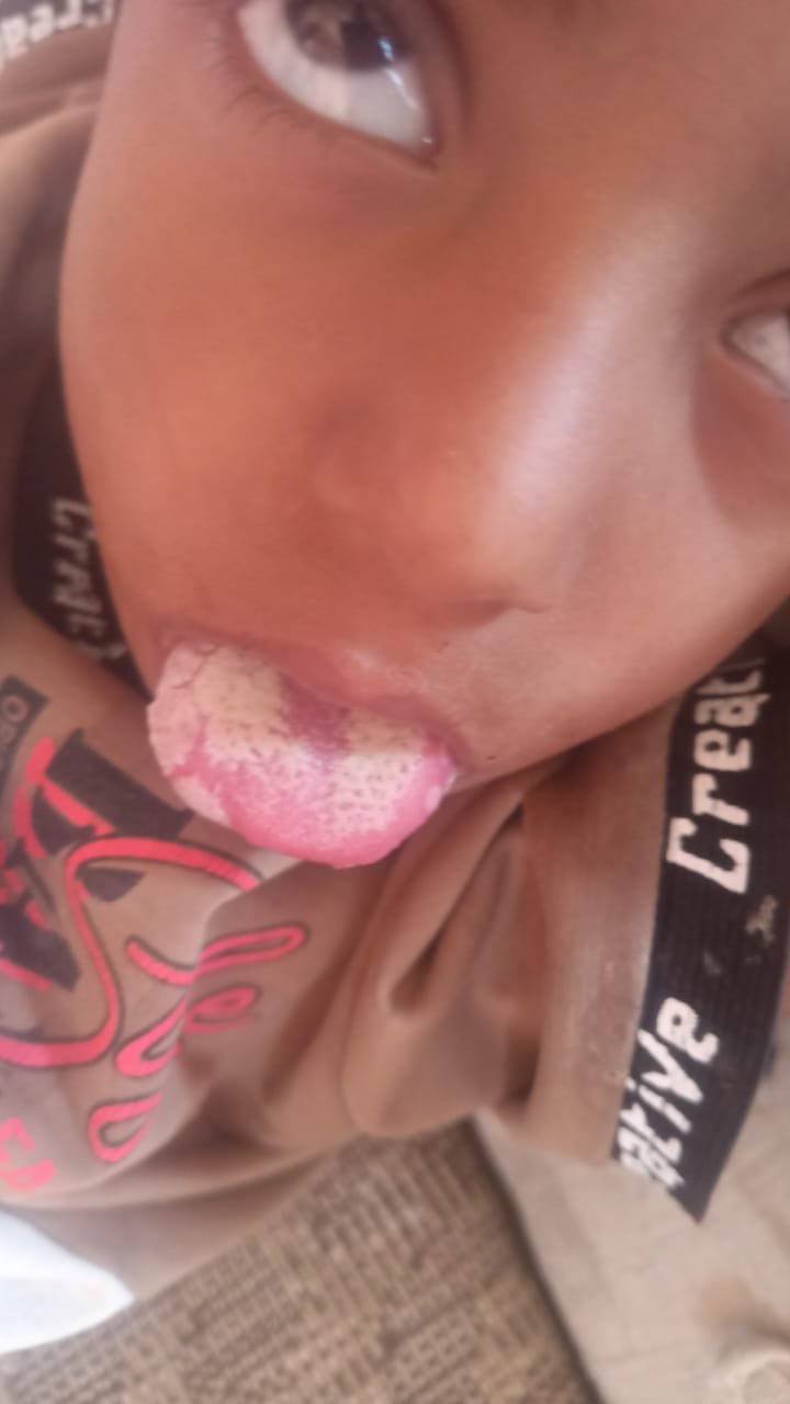 مناشدات عاجلة في الضالع جراء تفشي وباء فطريات اللسان بين أطفال منطقة تورصة